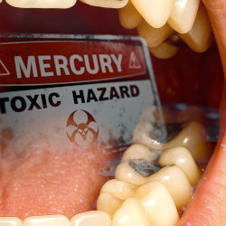 An open mouth with silver fillings and a toxic mercury sign